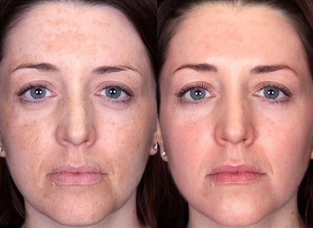 Nano Infusion before and after - skin tone improvement