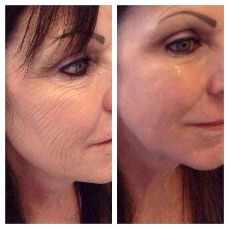 Nano Infusion before and after - wrinkle reduction