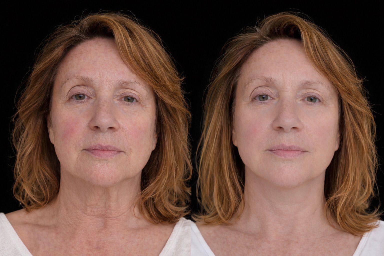 Nano Infusion before and after - skin rejuvenation results