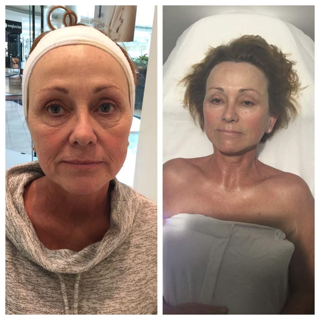 Nano Infusion before and after - facial rejuvenation